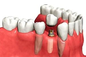 CIRUJANOS DENTISTAS CASTRO ROMO - PUENTES CIRUJANOS DENTISTAS CASTRO ROMO - PUENTES