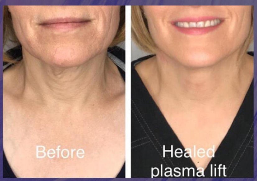Fibroblast (Plasma Pen) Insurance