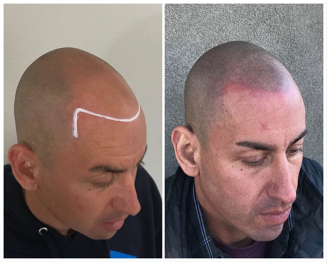 Side-by-side comparison of a hair transplant: pre-procedure with a drawn hairline on the left, post-procedure on the right.