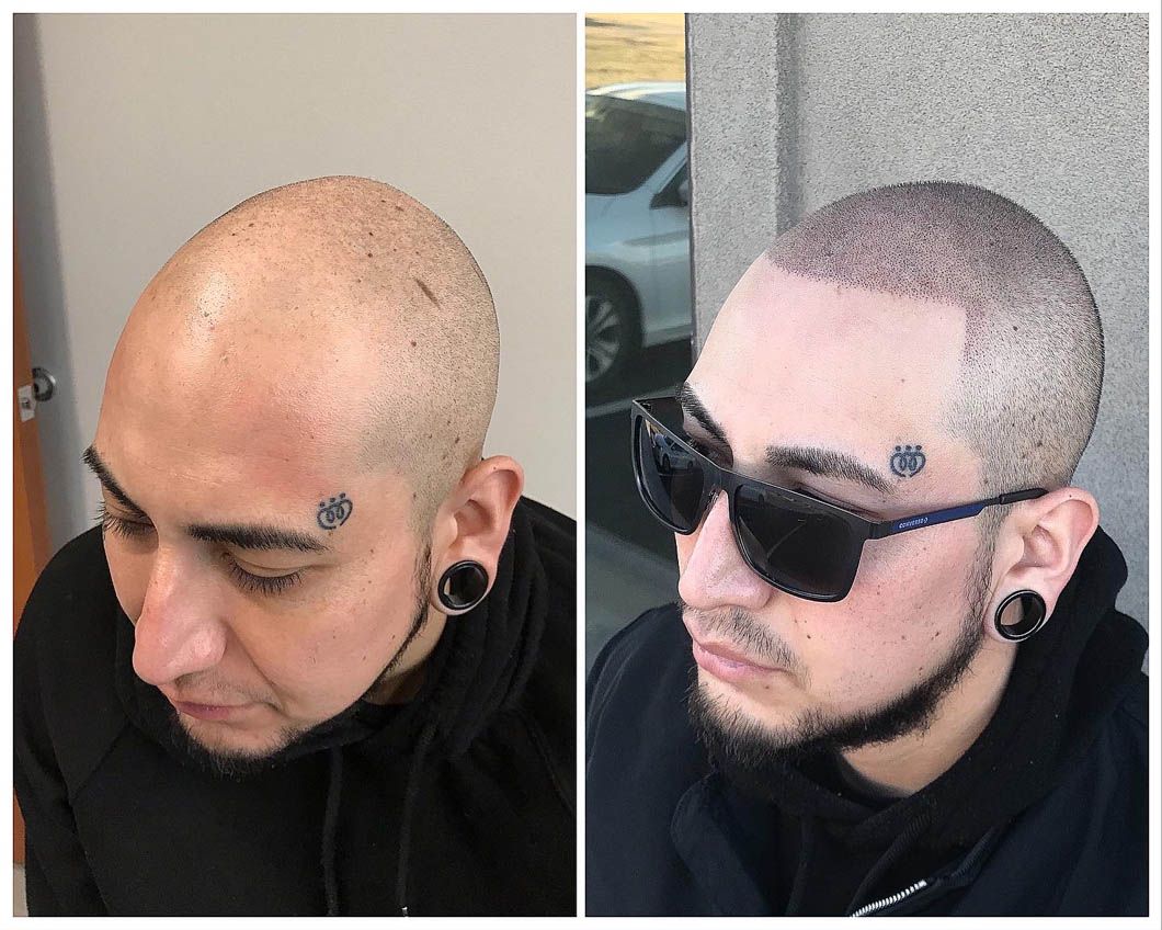 Two photos of a person’s head showing the results of a hair restoration procedure, with a close-up and a side profile view.