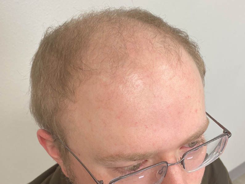 A close-up, high-angle view of the top of a person’s head showing thinning blonde hair and glasses against a plain wall.