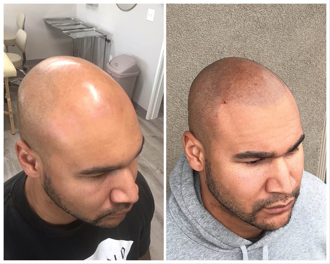 Before-and-after comparison of a person showing the results of scalp micropigmentation on a shaved head.