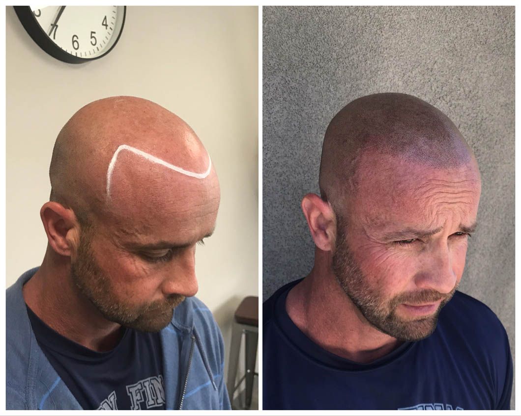 A split image showing a person's head before and after a hair transplant procedure, with a marked hairline on the left.