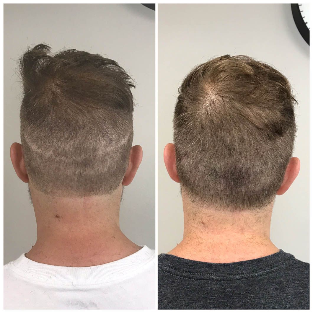 Split-screen view of the back of a head, showing hair growth progress before and after a procedure.