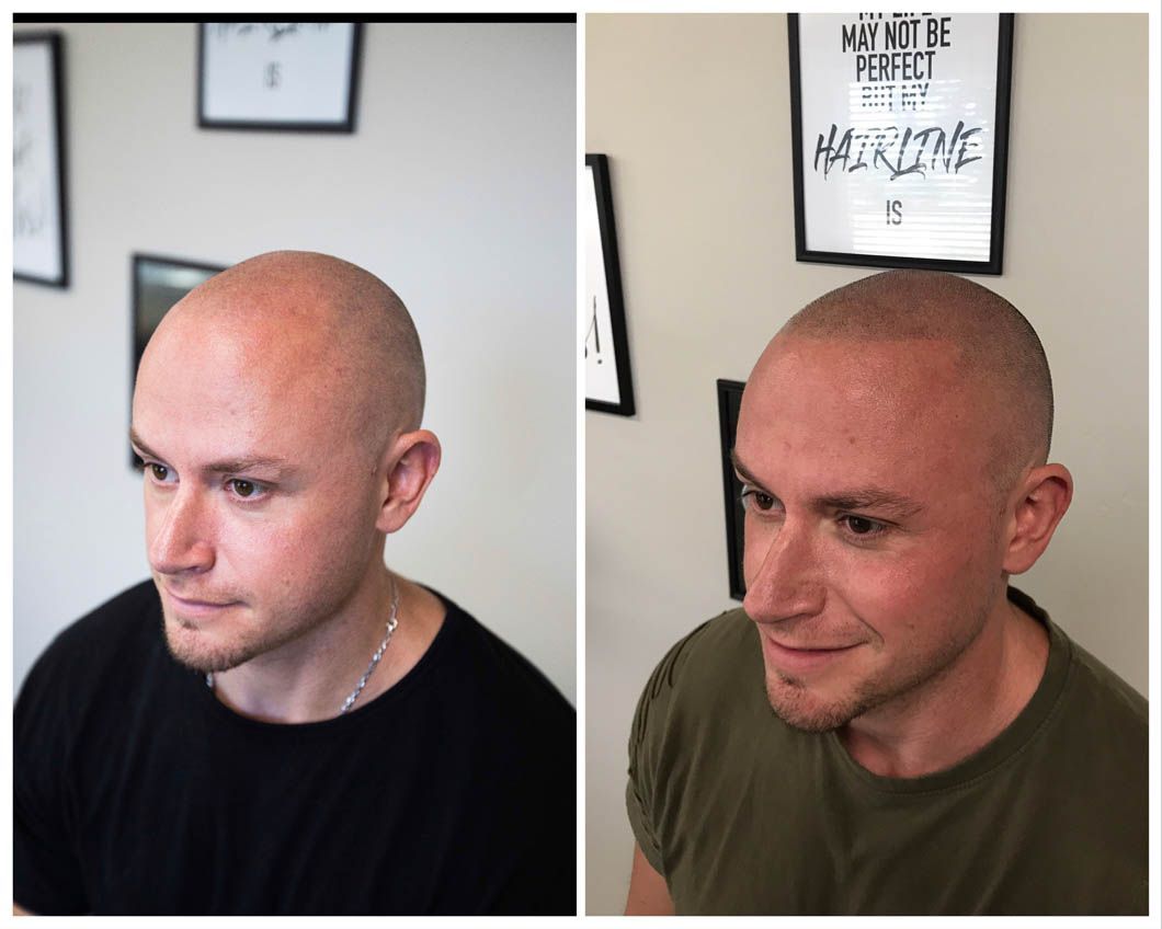 Before and after photos of a scalp micropigmentation treatment showing a fuller, denser look on the shaven head.