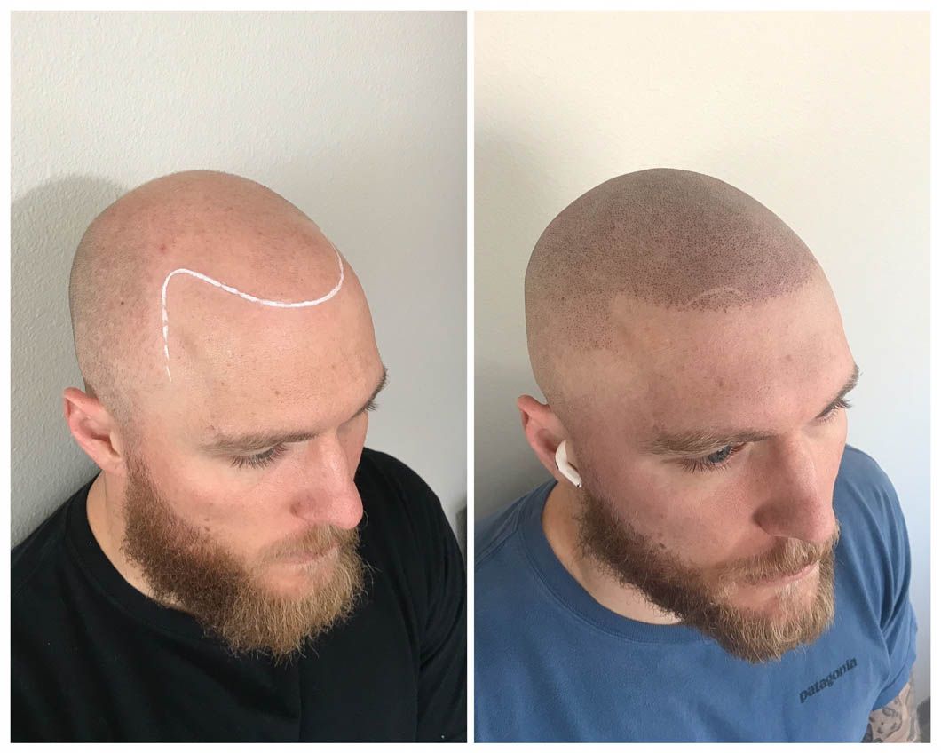 Before and after comparison of scalp micropigmentation showing a marked and then tattooed hairline on a shaved head.