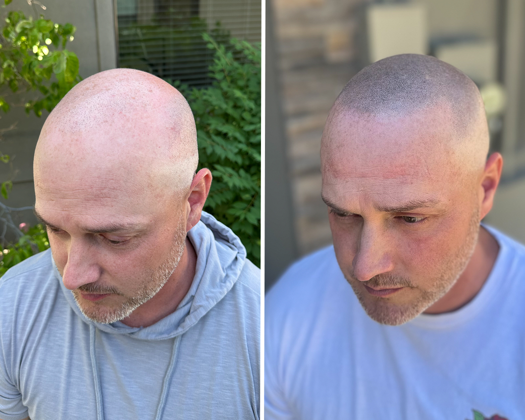 Before and after comparison of scalp micropigmentation, showing a light-skinned person's head before and after the procedure.