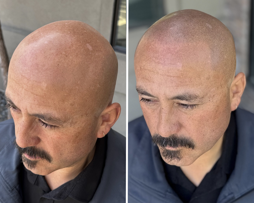 Before-and-after comparison showing a scalp micropigmentation procedure to create the appearance of a shaved head.