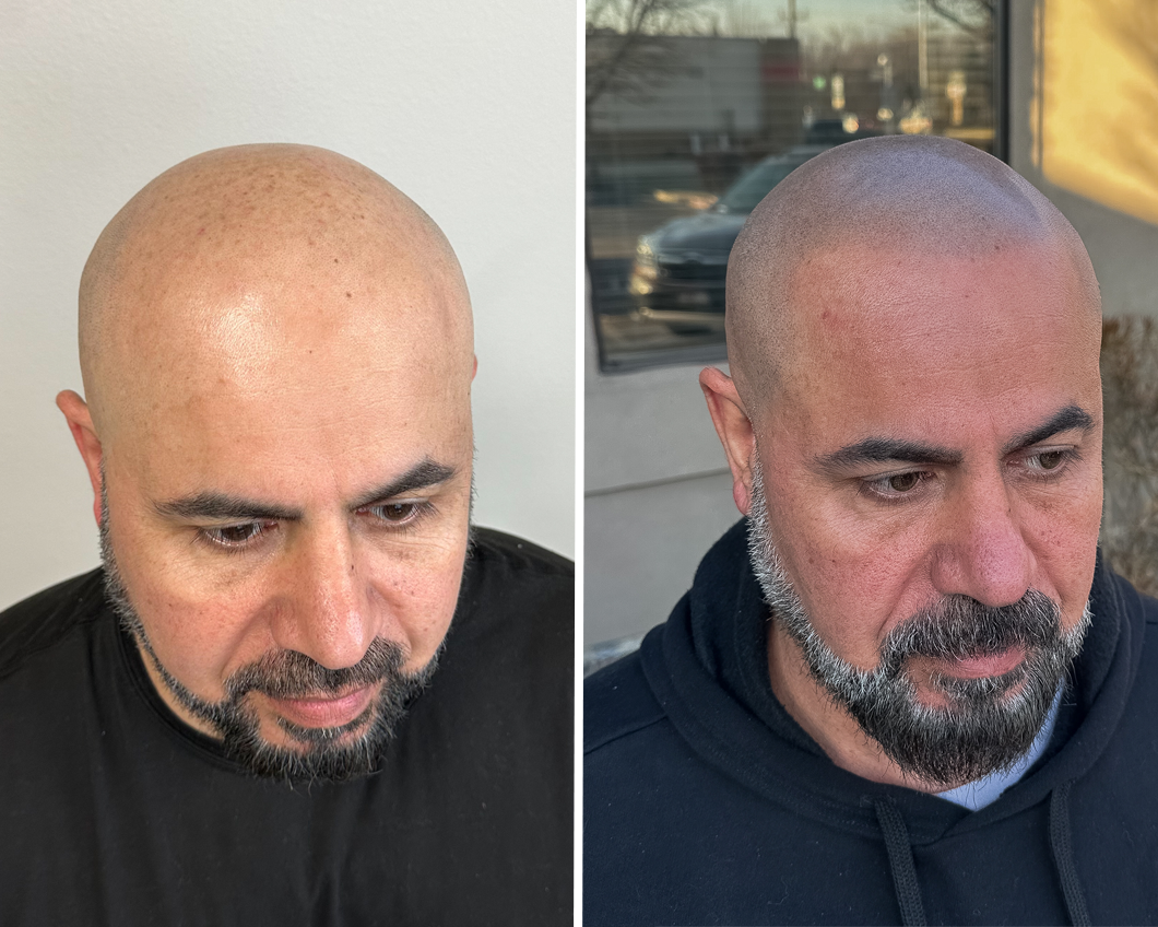 Before-and-after comparison of a person showing the results of scalp micropigmentation to simulate a shaved haircut.
