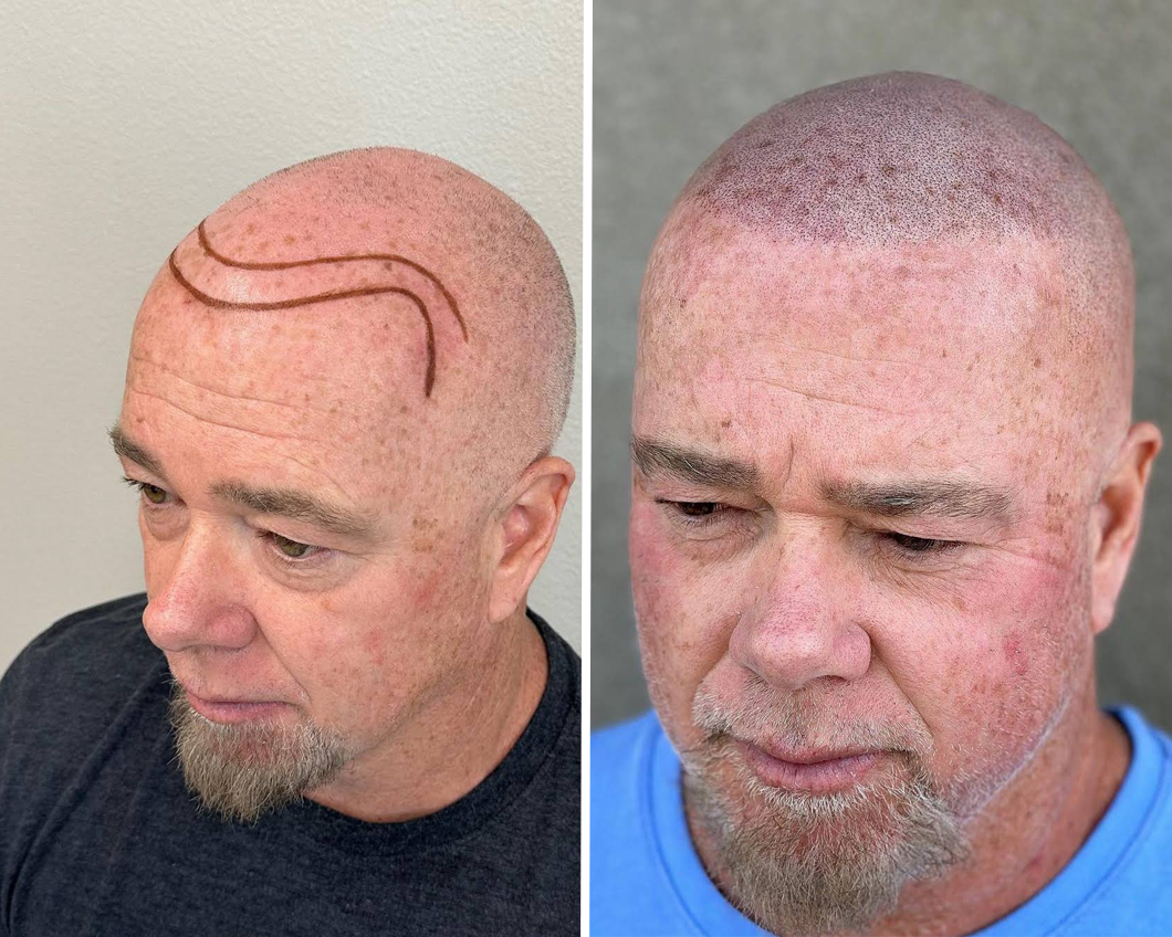 Before-and-after photos of a scalp procedure: markings for a new hairline on the left and freshly implanted hair on the right.