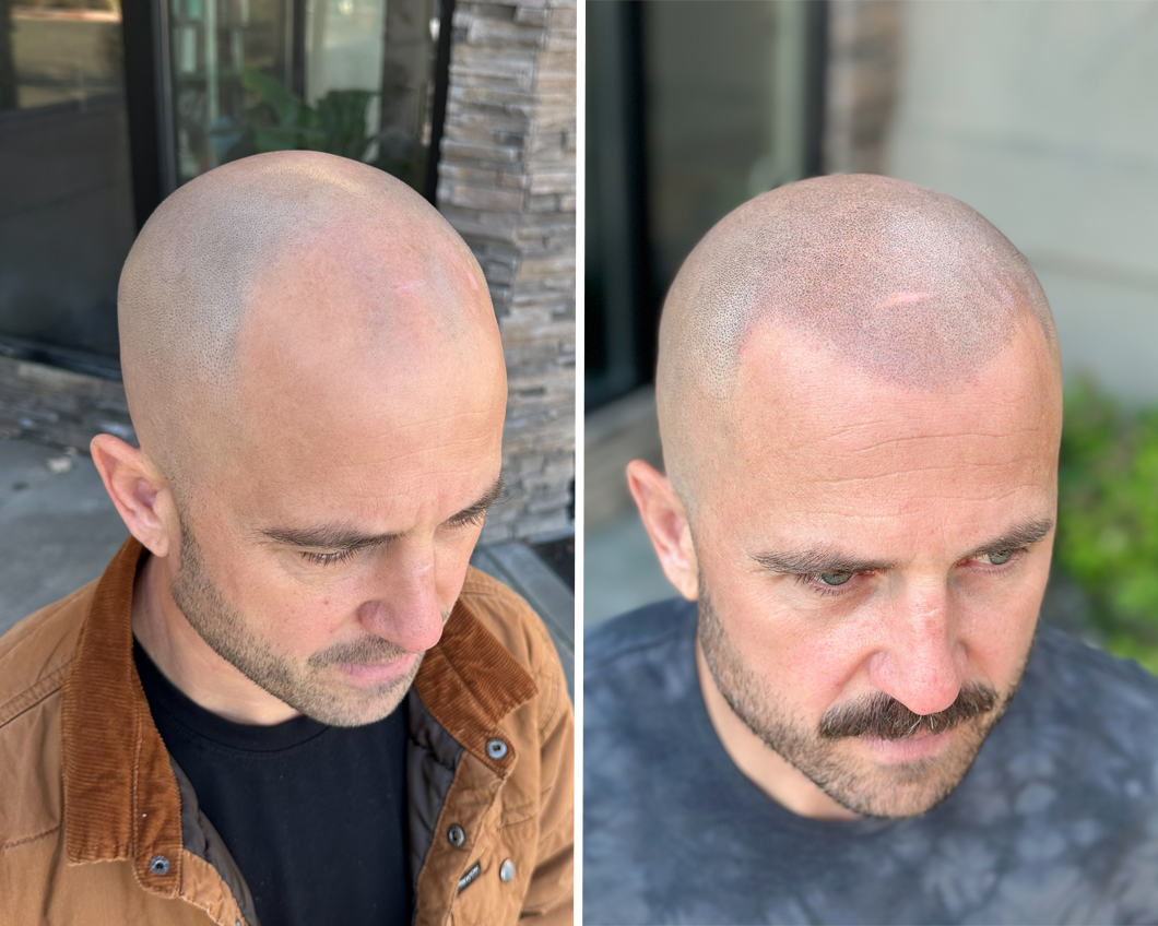 Before and after comparison of a scalp micropigmentation treatment showing increased hair density on the top of the head.