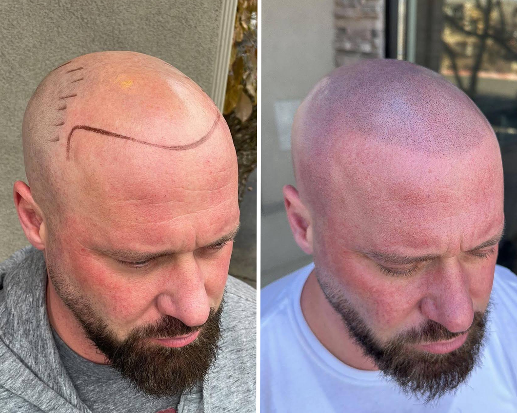Before and after comparison of scalp micropigmentation showing a marked hairline and the completed tattoo treatment.