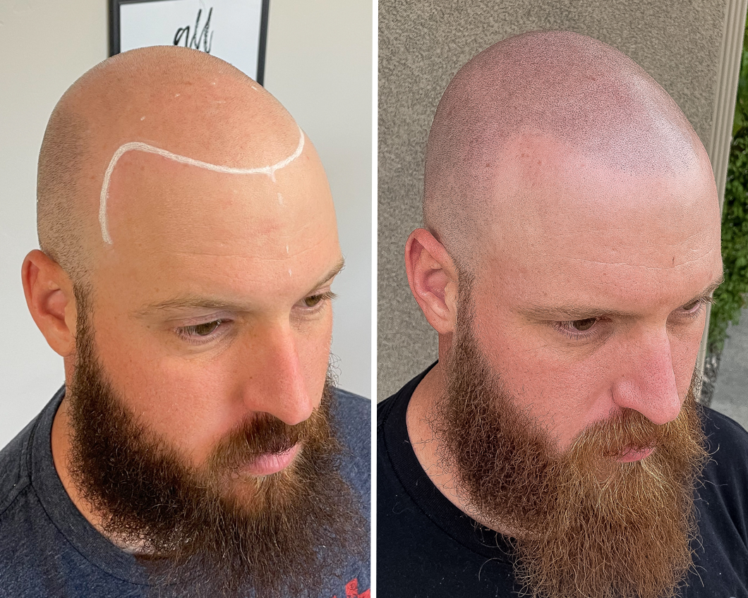 A split-screen view showing a person before and after scalp micropigmentation, with a white hairline outline in the first.