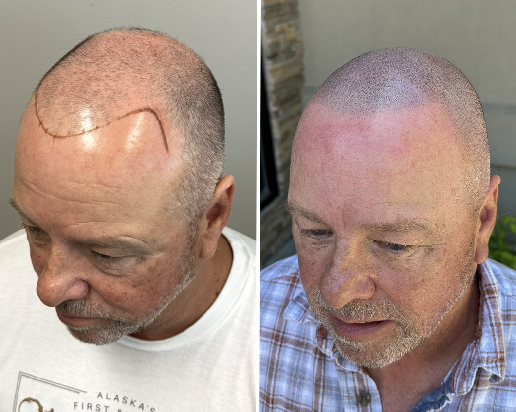 A comparison of a man's scalp before and after Scalp Micropigmentation (SMP) to cover a hairline scar.