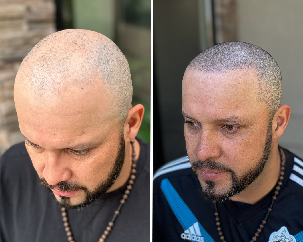 Before-and-after photos of a man showing scalp micropigmentation, resulting in a fuller, shaved-head appearance.