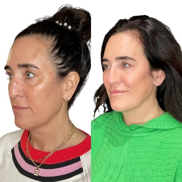 before and after