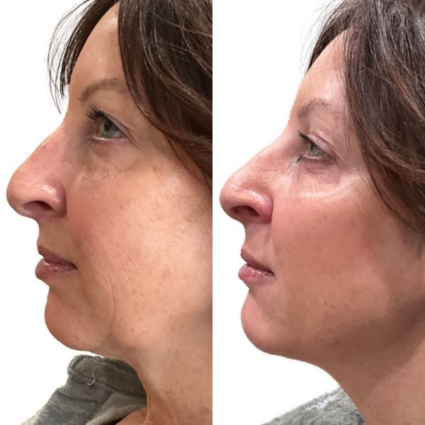 before and after