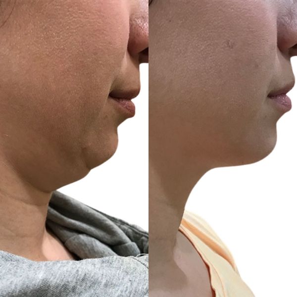 before and after image
