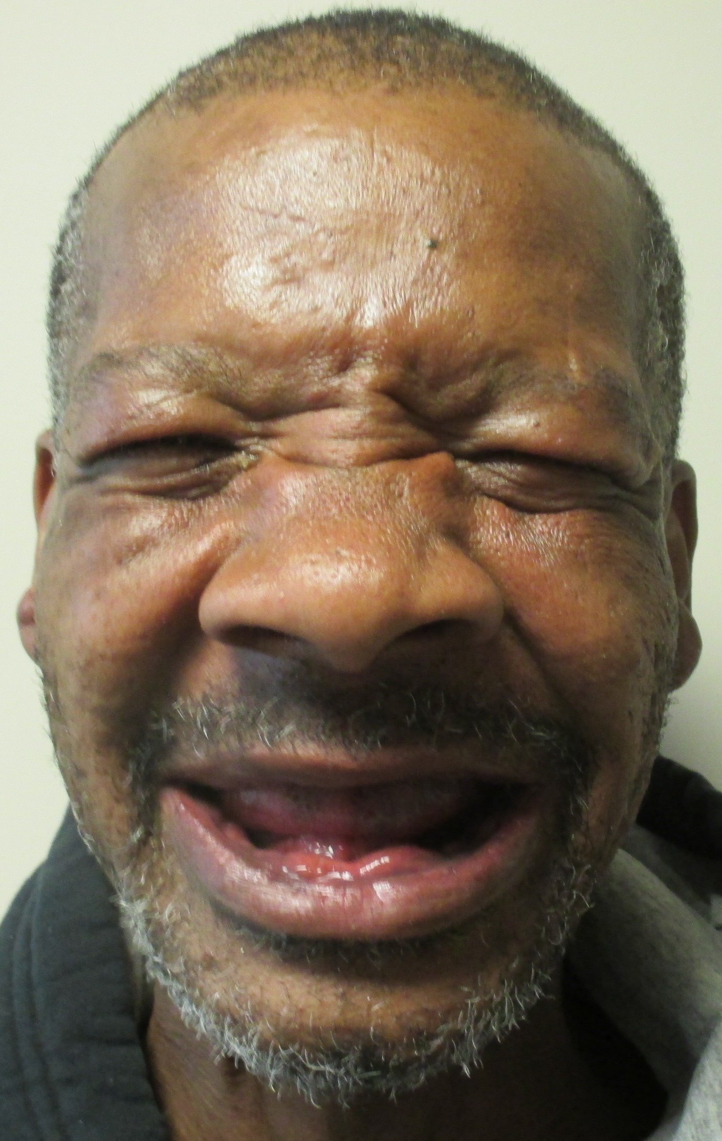 SnapIn Dentures in Sterling VA Implant Supported Dentures