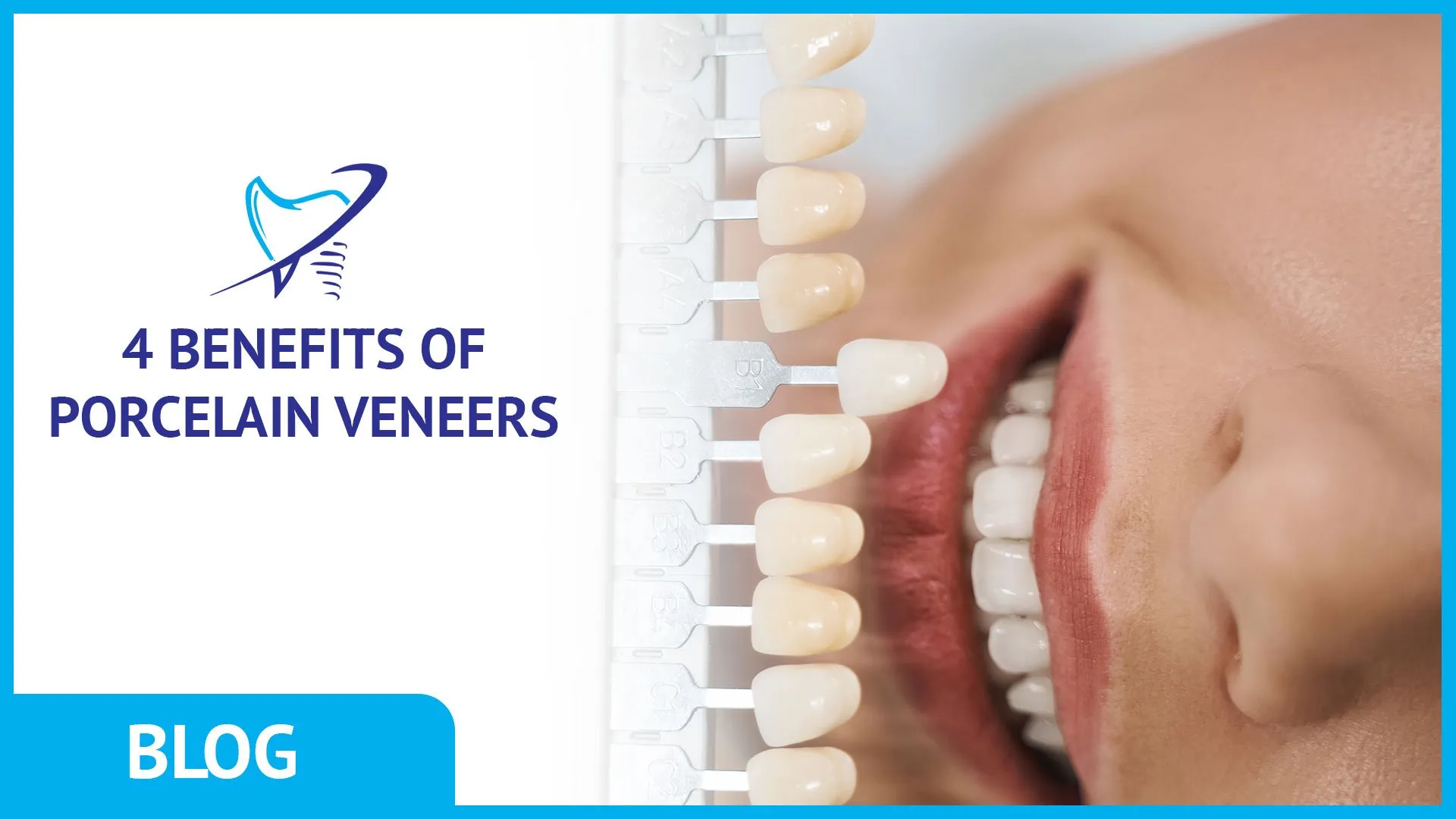 4 Benefits of Porcelain Veneers
