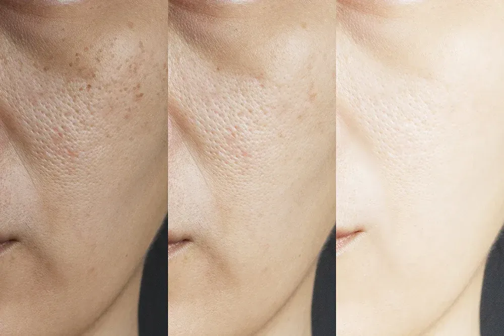 Close-up comparison of skin before and after treatment, showing reduced dark spots and smoother texture.
