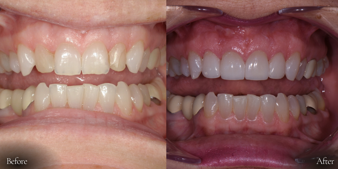 Side-by-side teeth comparison: Before has yellowish teeth. After has whiter, straightened teeth.