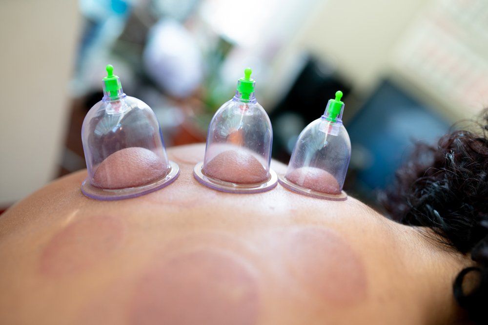 Three clear suction cups attached to a person's back, surrounded by circular marks from previous cupping sessions.