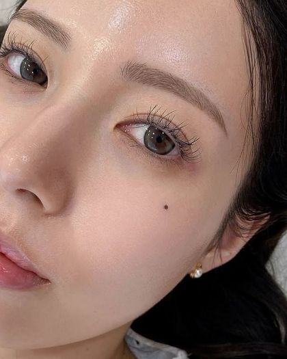 Top: Hair thinning on forehead. Bottom: Hairline after treatment.