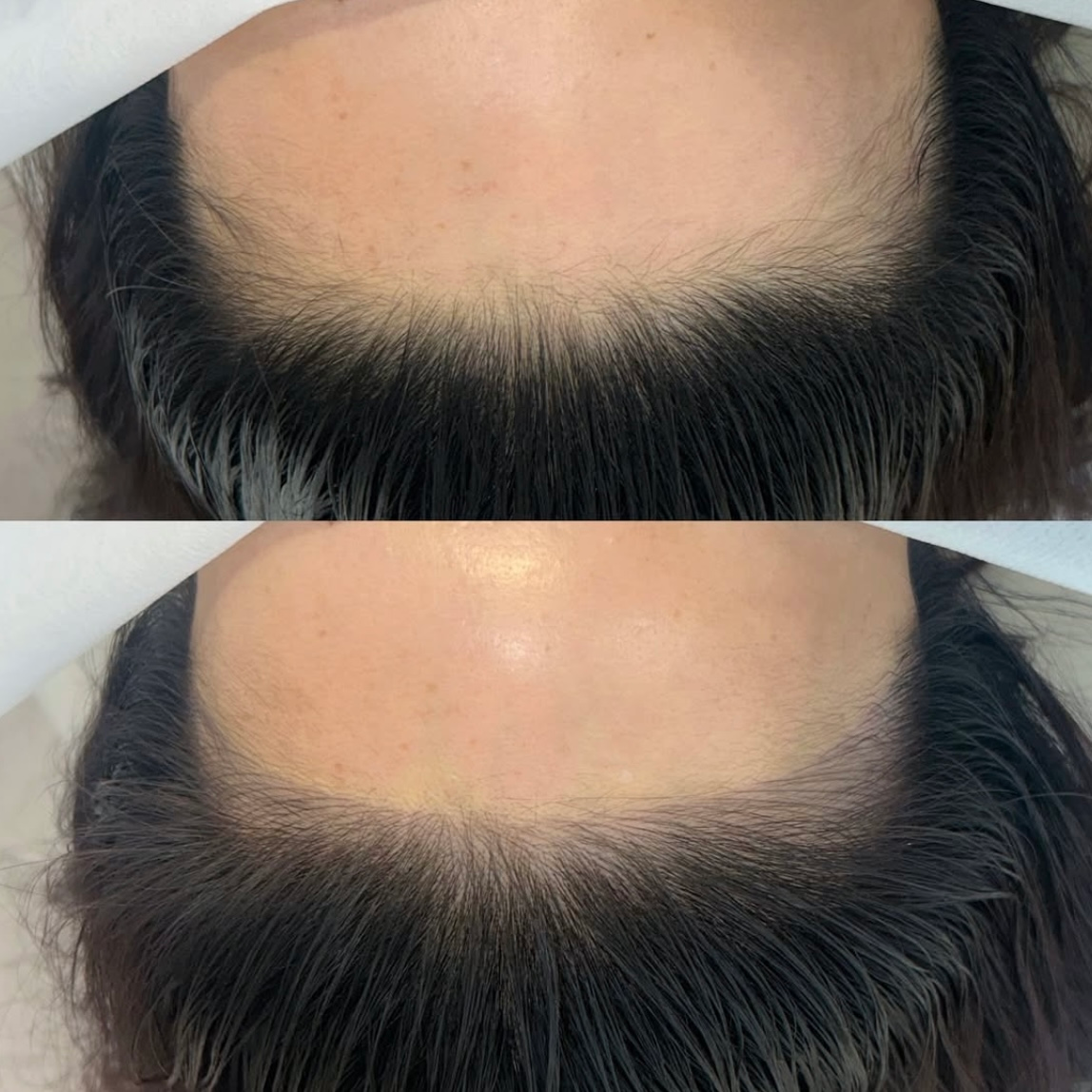 Close-up of a hairline before and after treatment, showing thicker hair coverage below the forehead