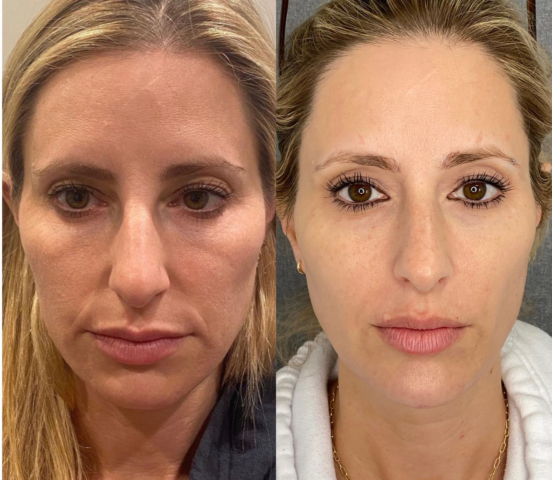 Collagen Treatments Redondo Beach | Uplifted Aesthetics Skin Tightening