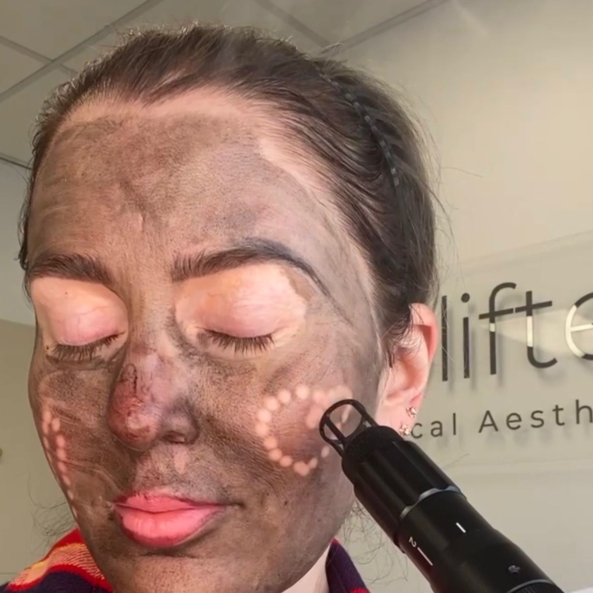 Woman with charcoal facial mask, undergoing laser treatment; setting is a medical aesthetic clinic.