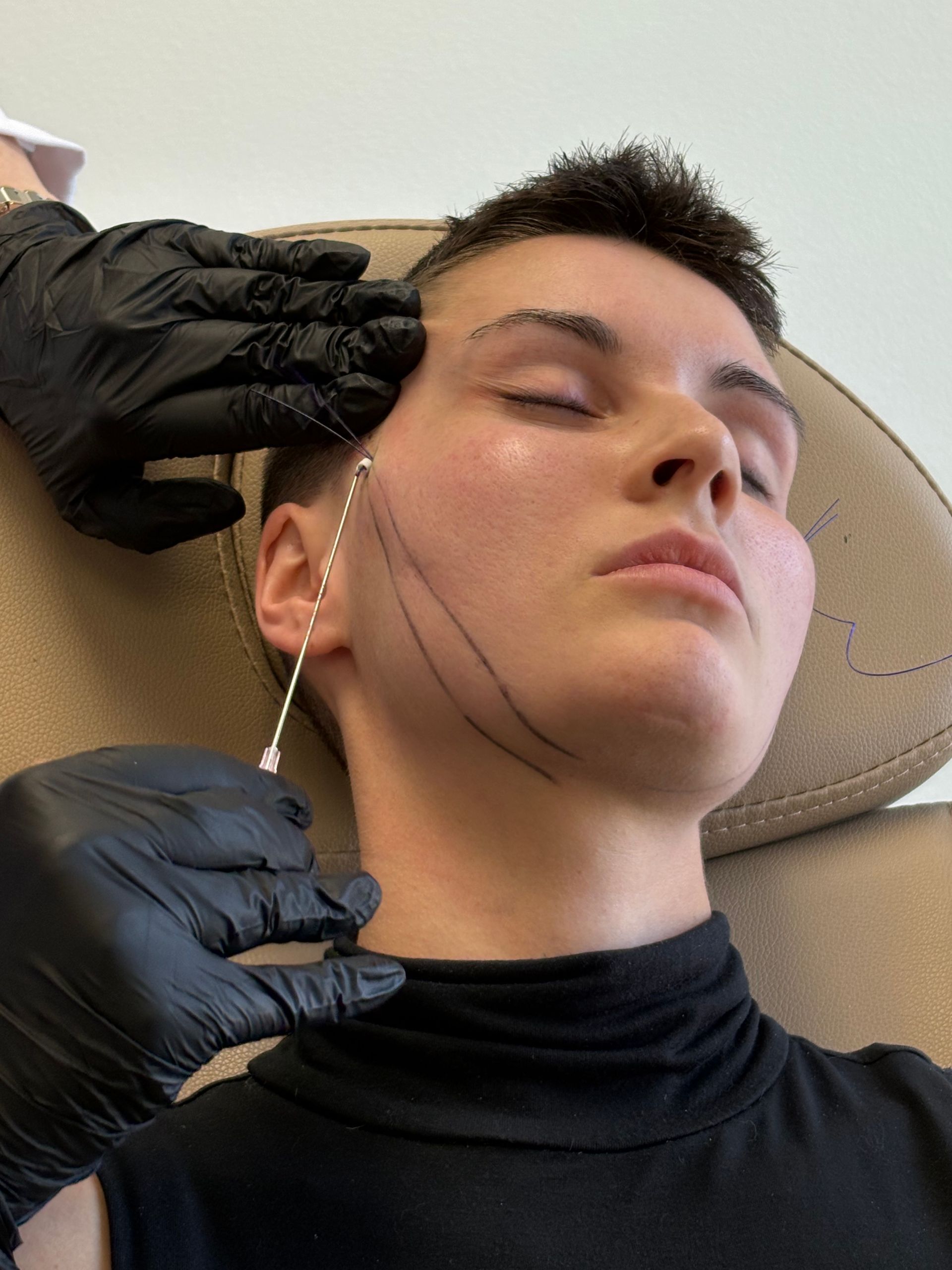 Woman's face with surgical markings and cosmetic needles, highlighting areas for procedures.