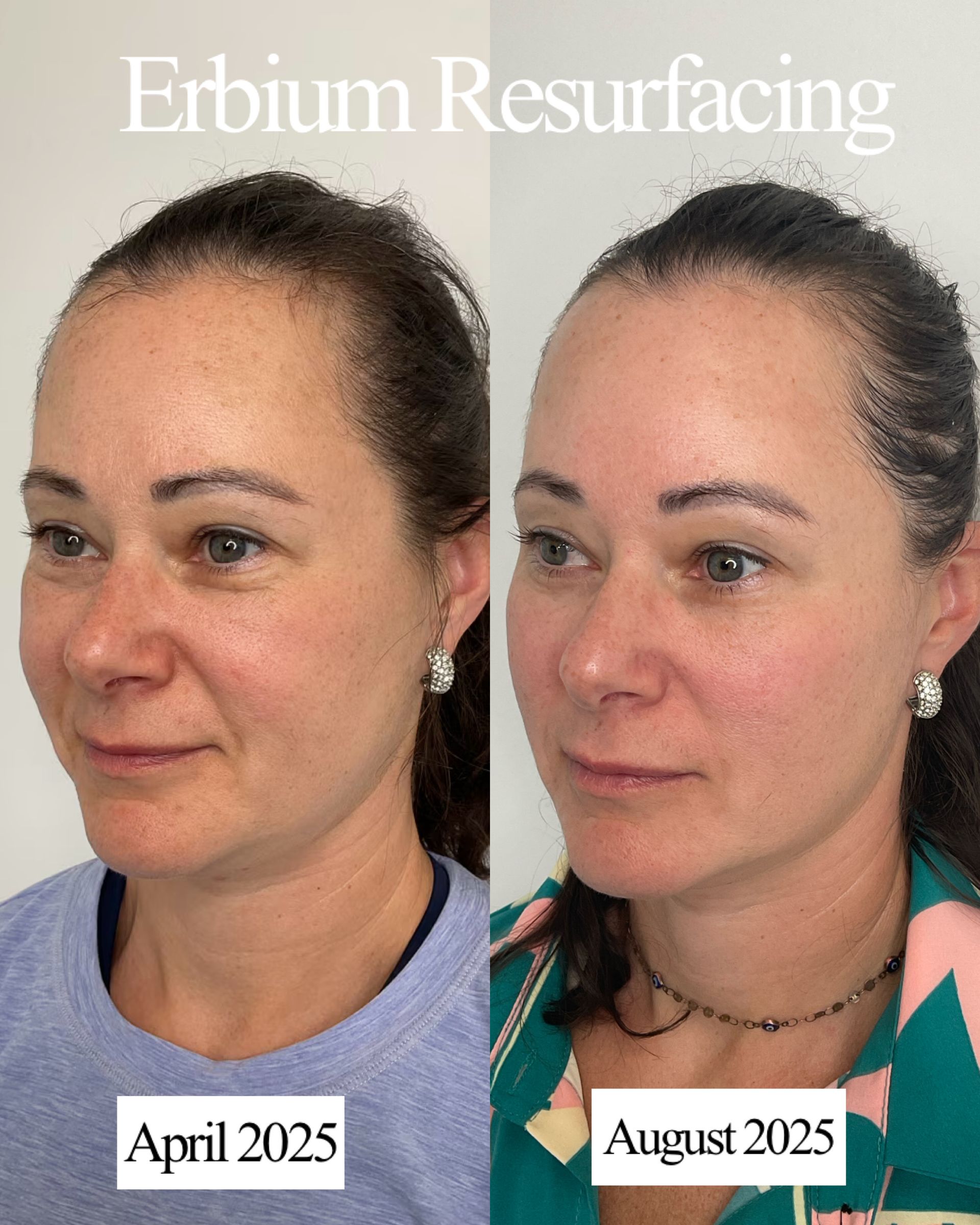 Hyperpigmentation Treatment Redondo Beach | Uplifted Aesthetics