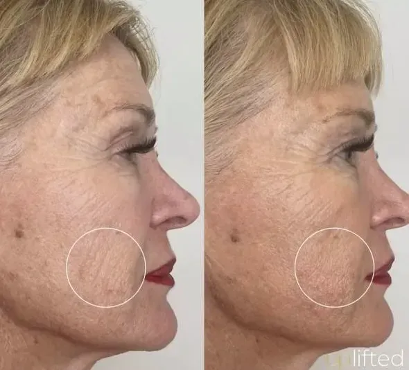 Side-by-side comparison of woman's face before and after a cosmetic procedure, showing reduced wrinkles.