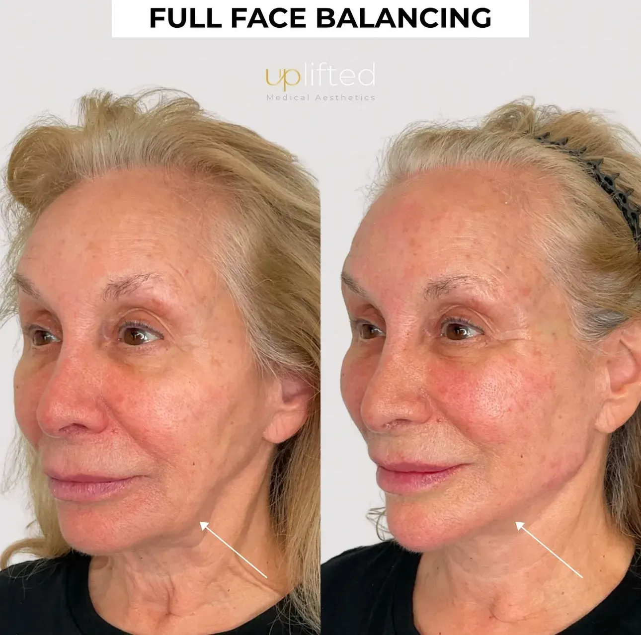 Side-by-side comparison of a person's face. Left side shows before, right side shows after full face balancing.