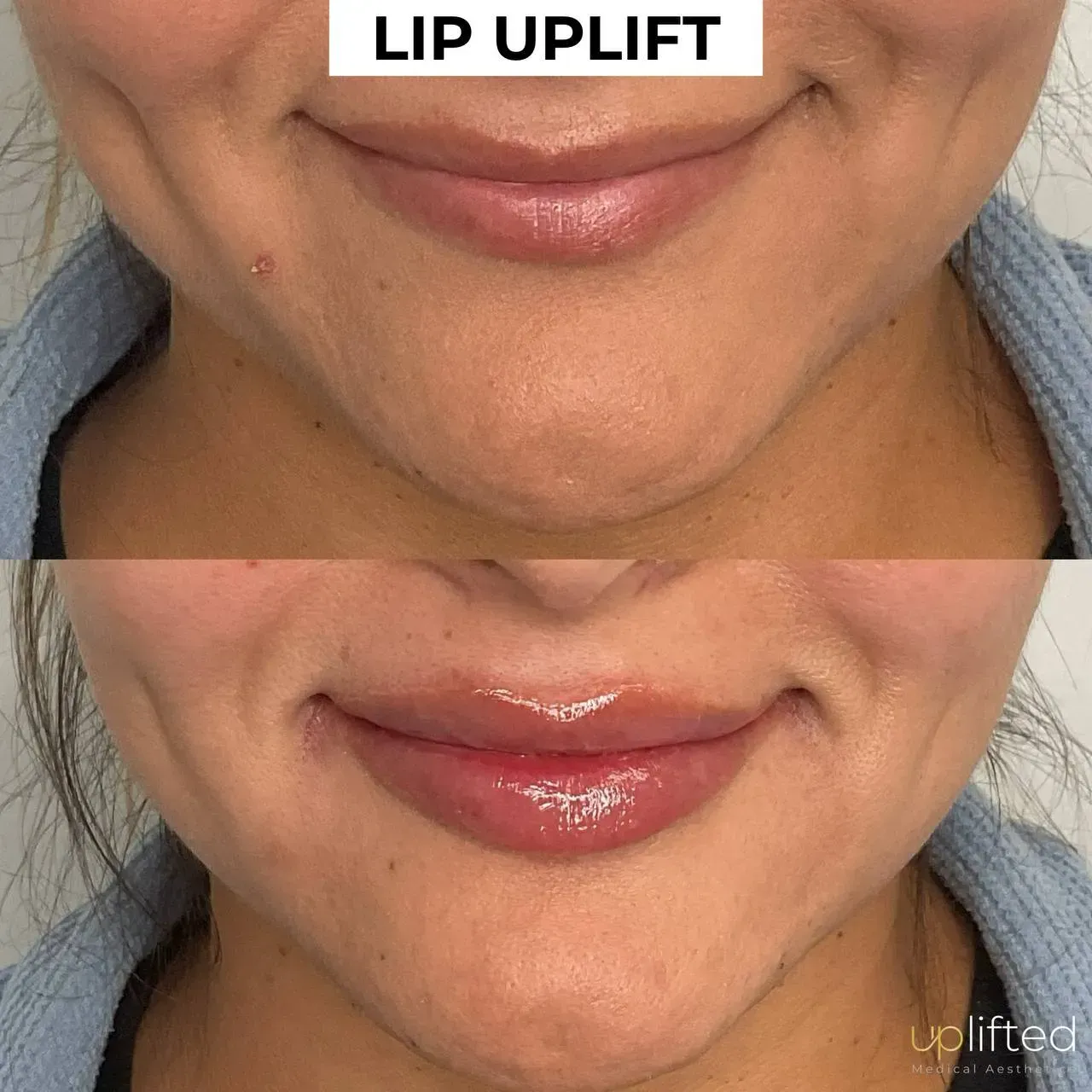 Side-by-side comparison shows a person's lips before and after a lip lift procedure.