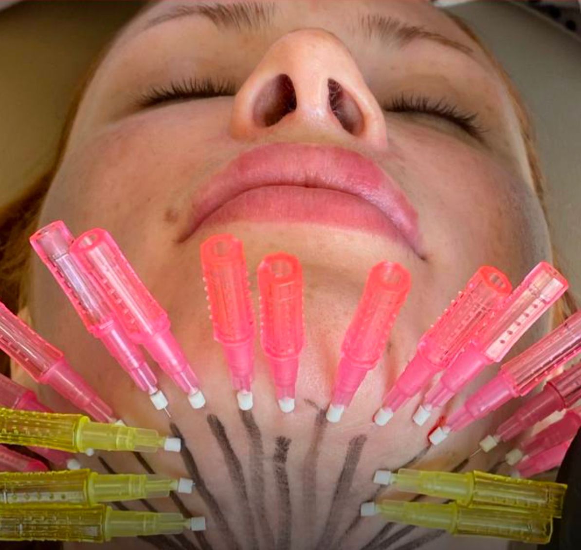  A patient with PDO Threads in her lower face at Uplifted Aesthetics in Redondo Beach, CA