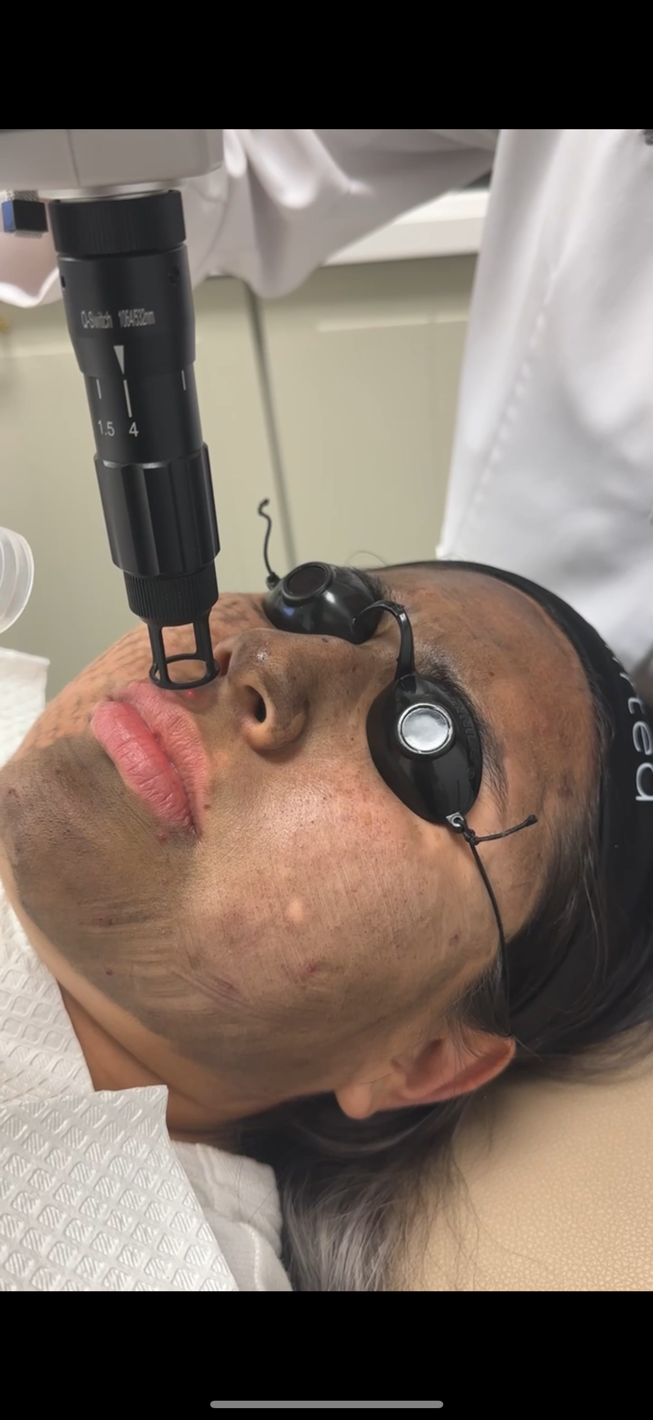 Person undergoing facial laser treatment, wearing protective eye goggles. The laser device is pointed at their nose and face.