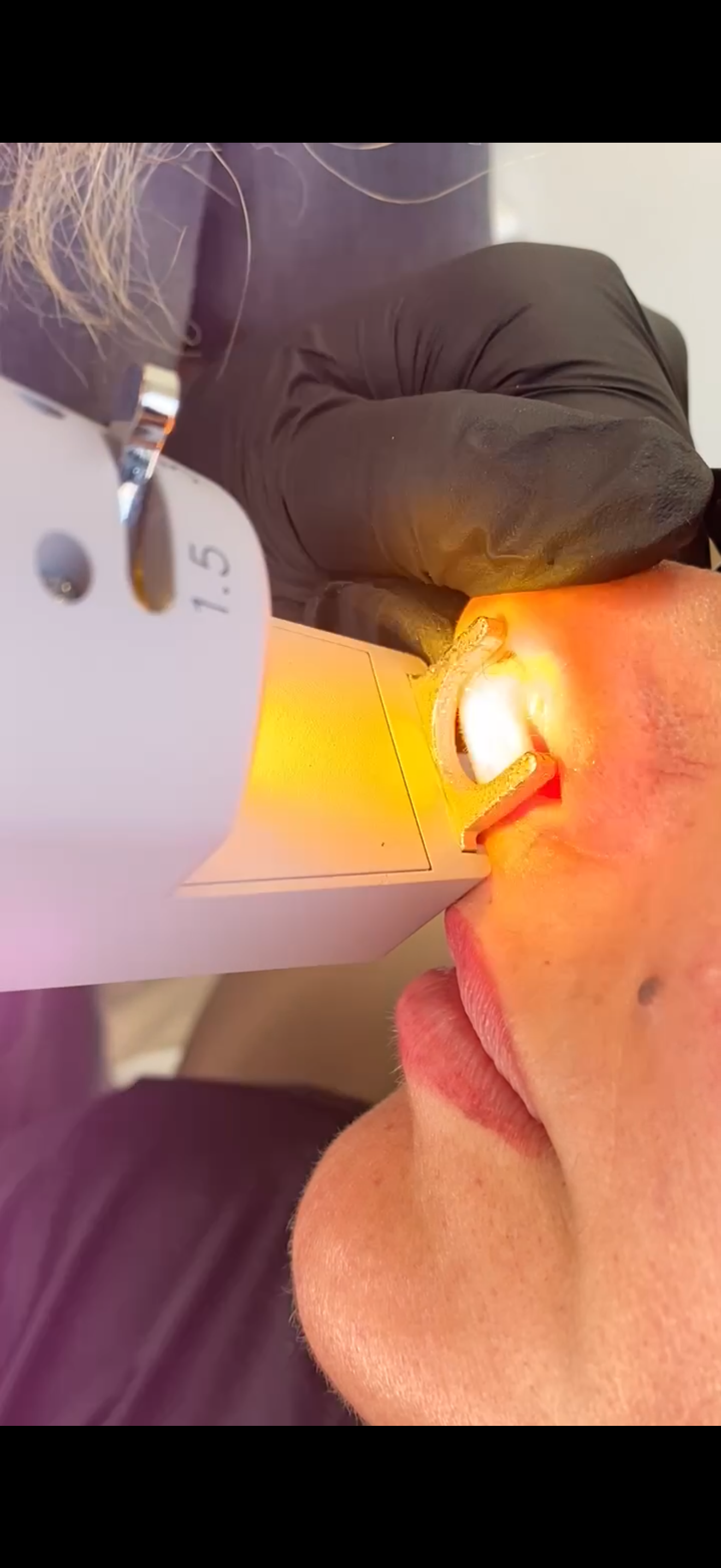 Person receiving eye treatment with a bright light, held by a person wearing a black glove.