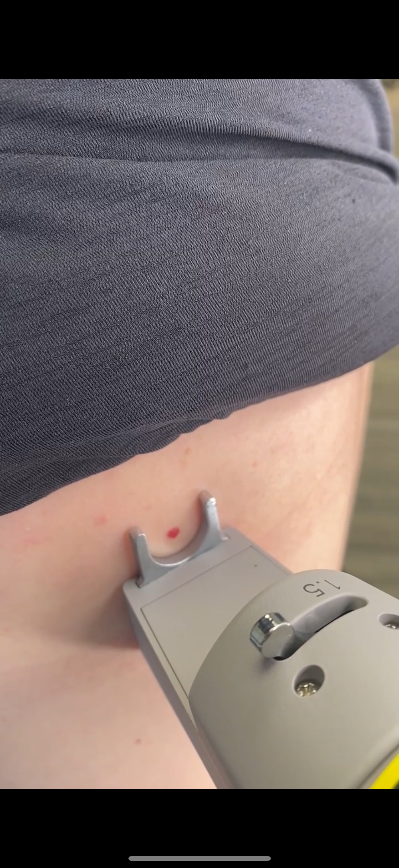 A device is positioned near a person's skin, likely for a medical procedure.