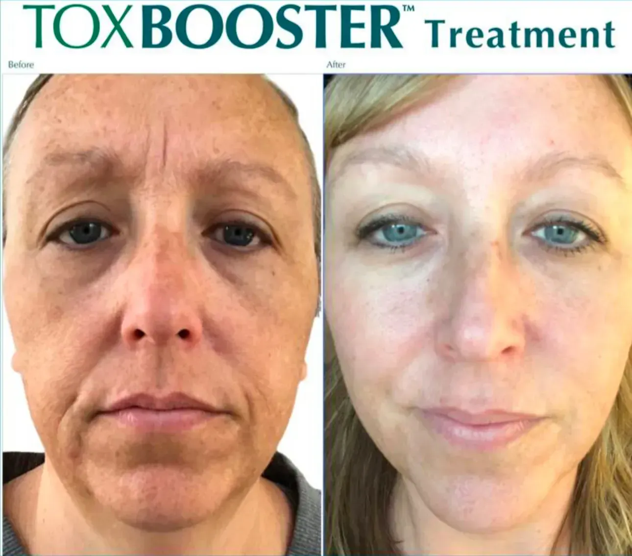 Before and after faces, showcasing ToxBooster treatment. Before: aged face. After: smoother, more youthful appearance.