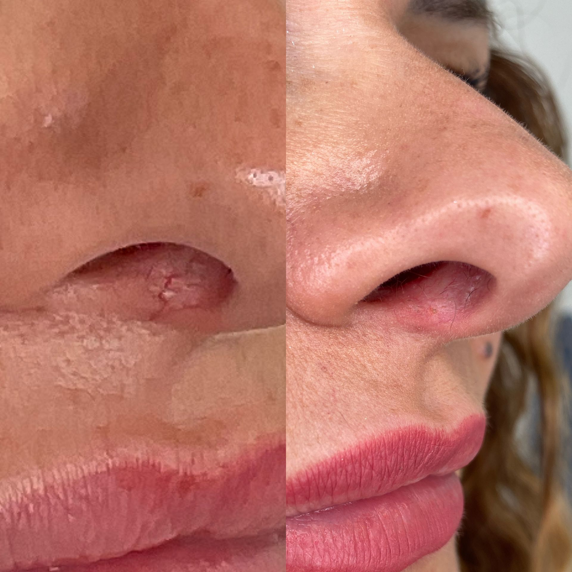 Before and after photos showing nose with growth removed.