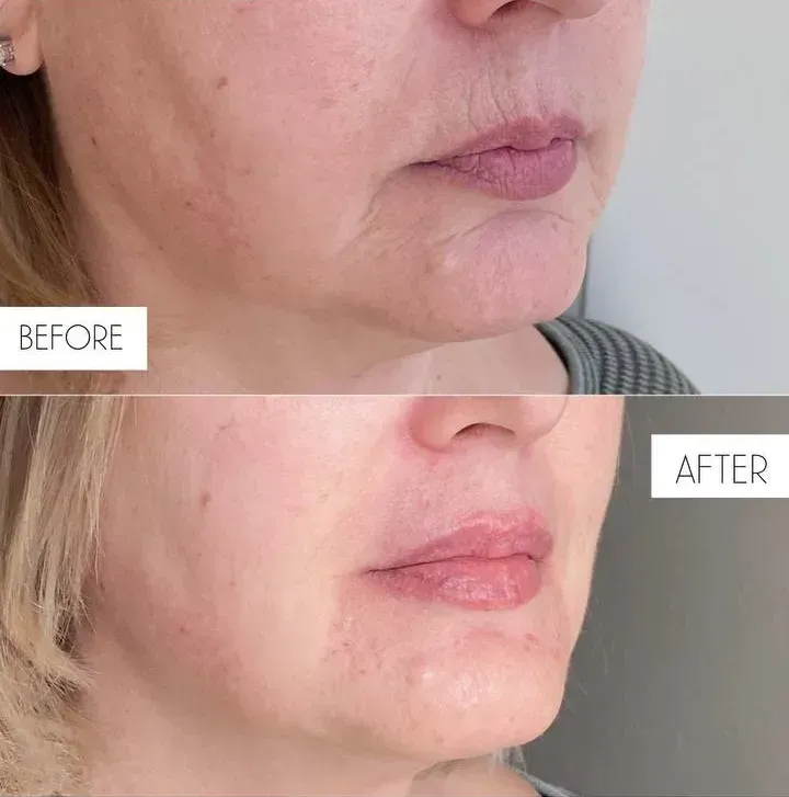 Comparison of a person's lower face before and after a treatment, showing reduction in wrinkles and improved skin tone.