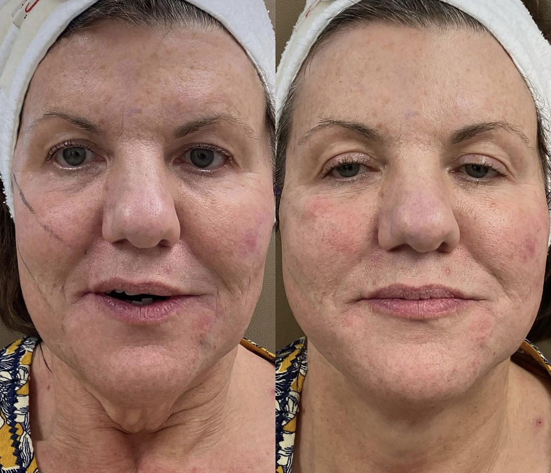 Side-by-side comparison of a person's face. Left side: mouth open. Right side: mouth closed, skin appears smoother.