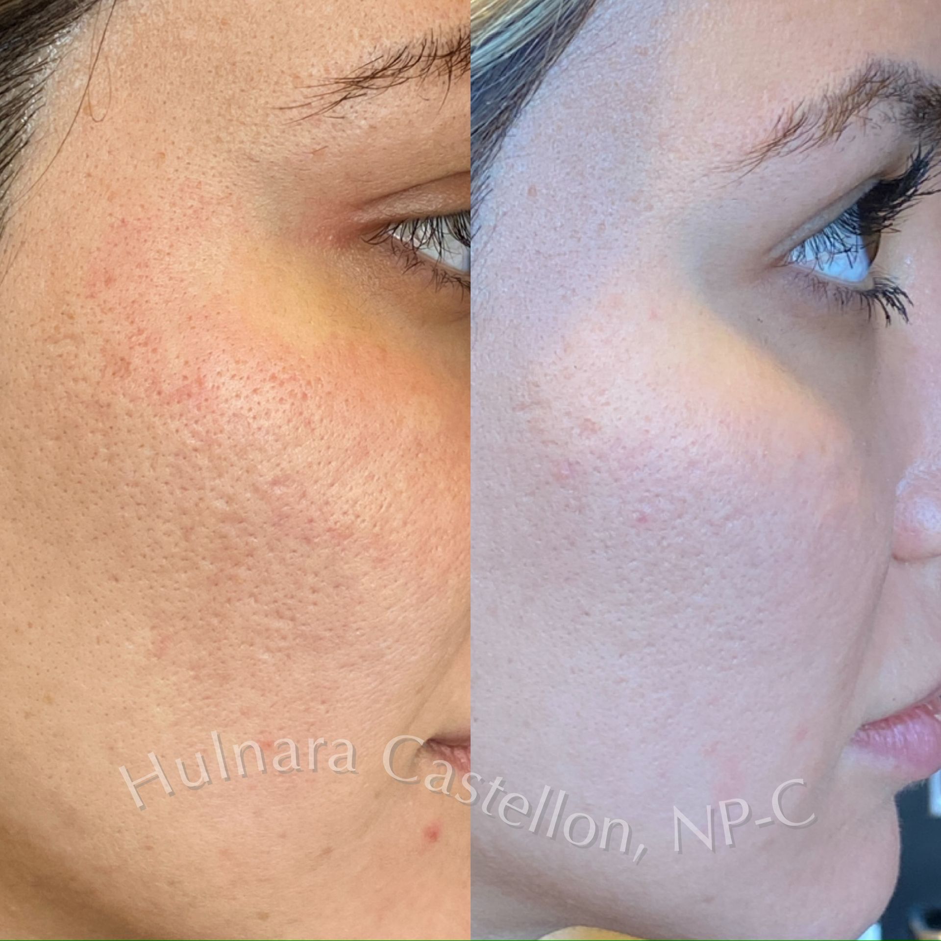 Before and after view of a person's cheek. Left side has visible pores and redness, right side has smoother skin.