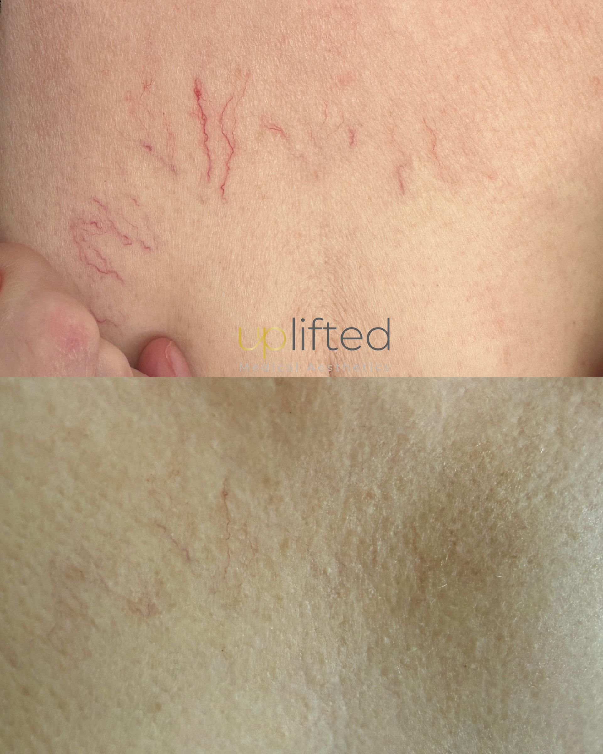Leg with visible spider veins before a vein treatment at Uplifted Aesthetics.