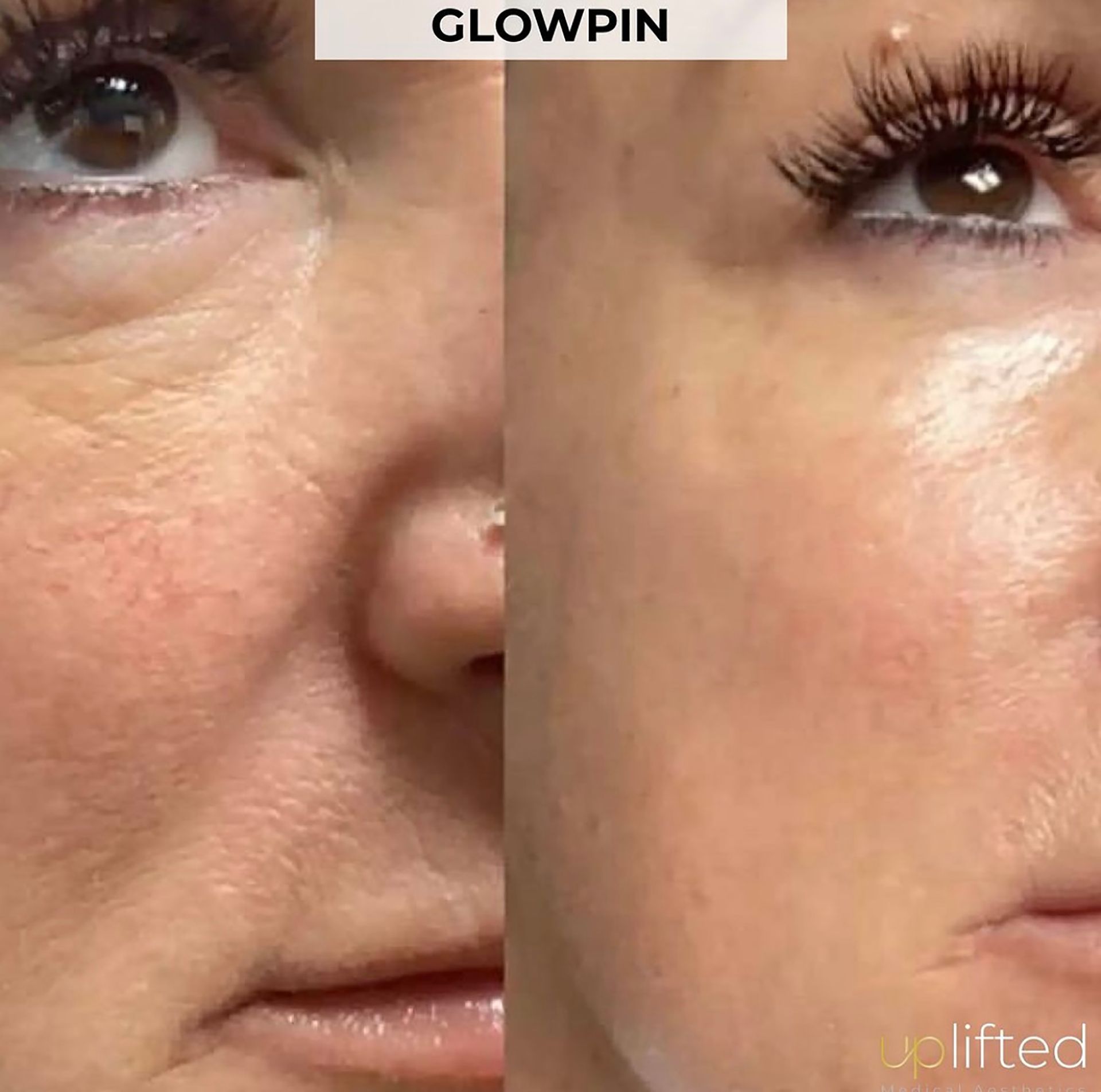 Before and after photos of a person's face showing reduced wrinkles and improved skin tone.