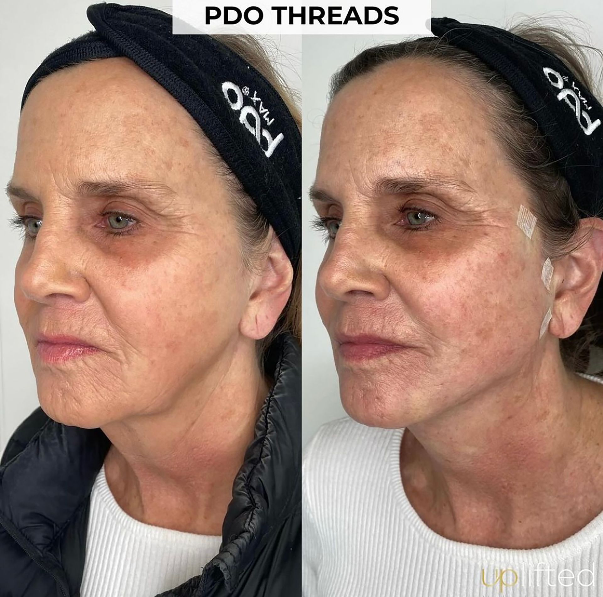 Before and after photos of a person's face; post-PDO threads, showing reduced wrinkles and lifted appearance.
