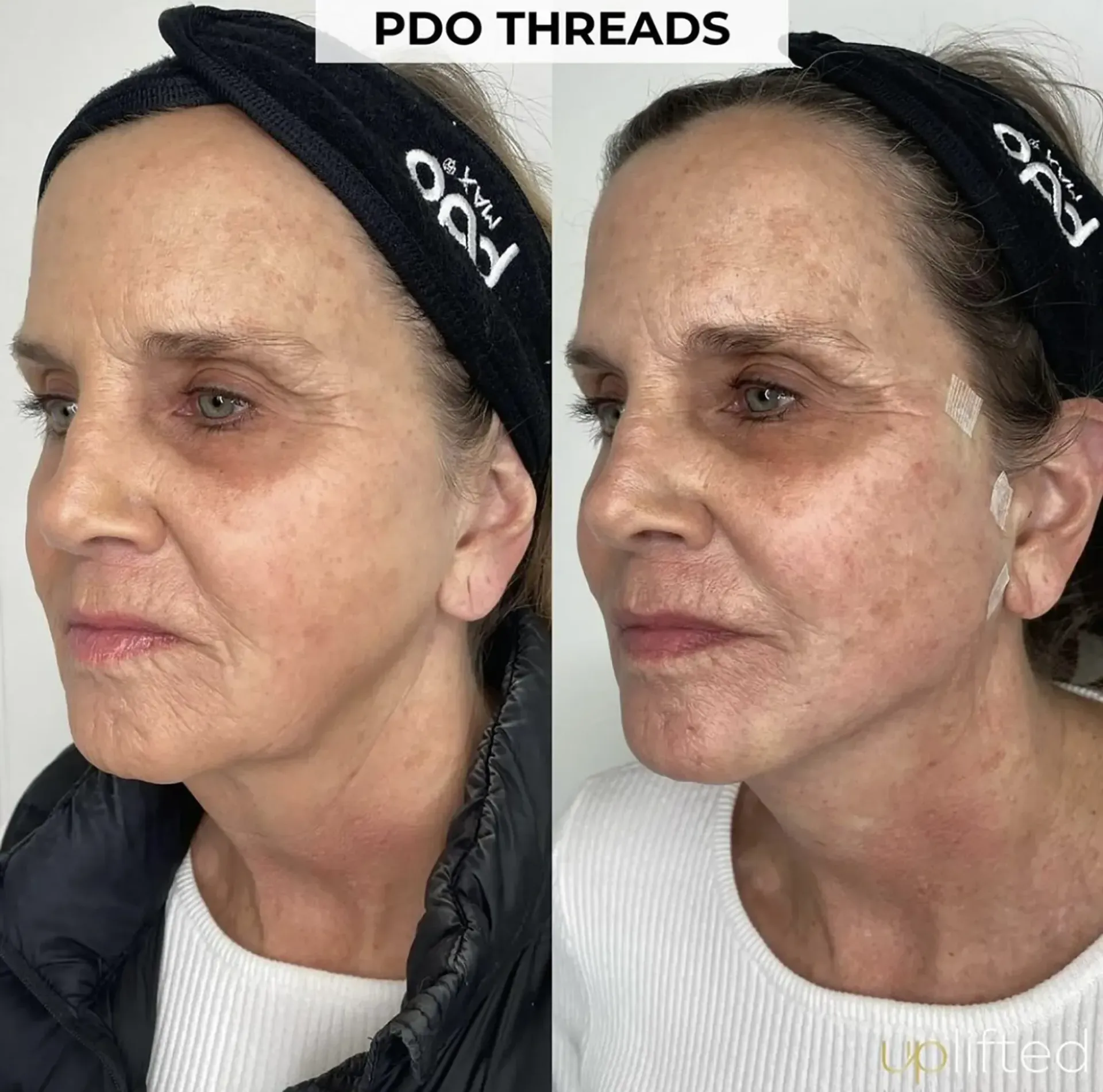 Side-by-side comparison. Woman before and after PDO thread treatment, with a headband and slight bruising.