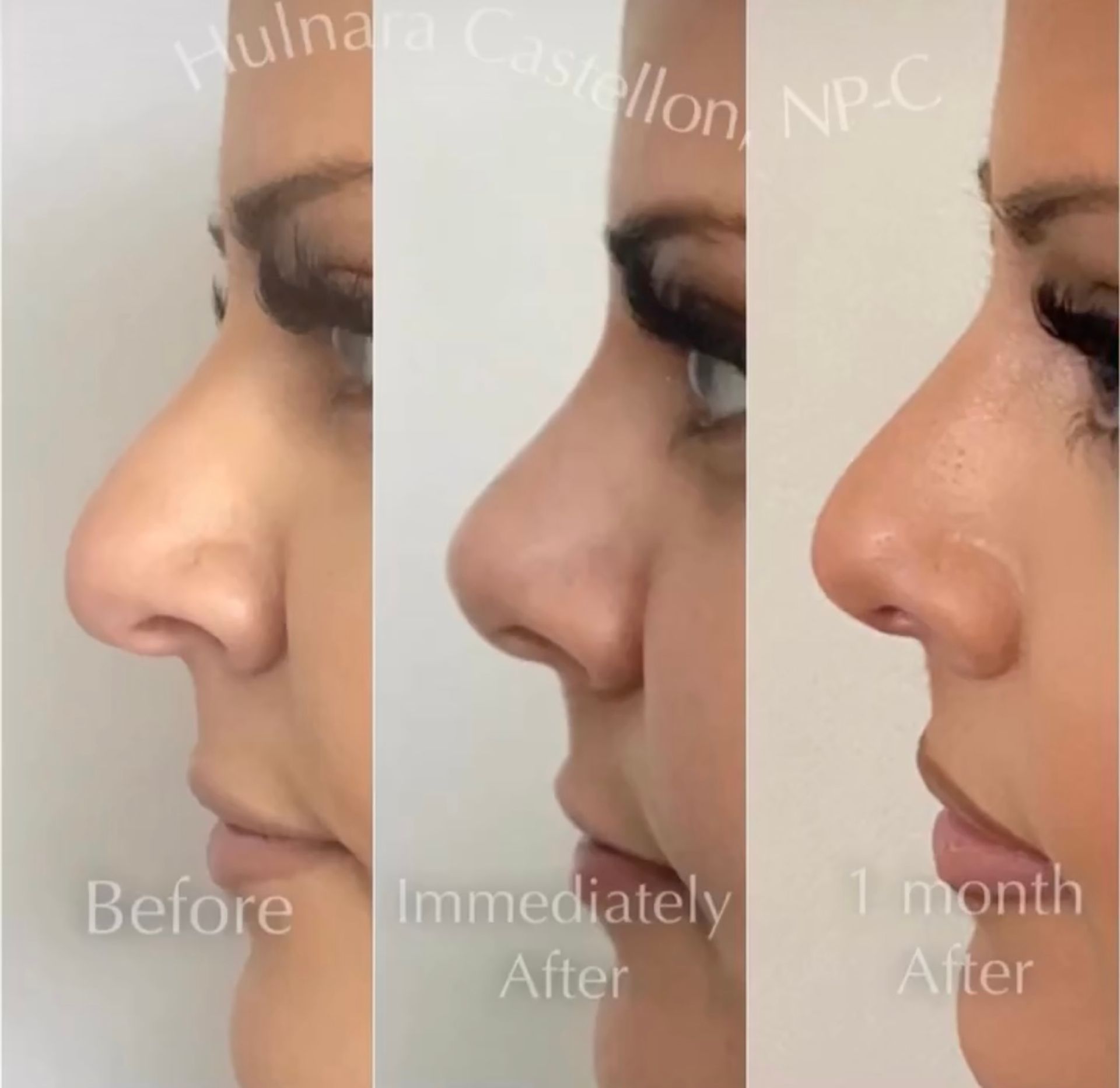 Three-panel image showing a person's profile before and after nose reshaping; the last panel is one month after.